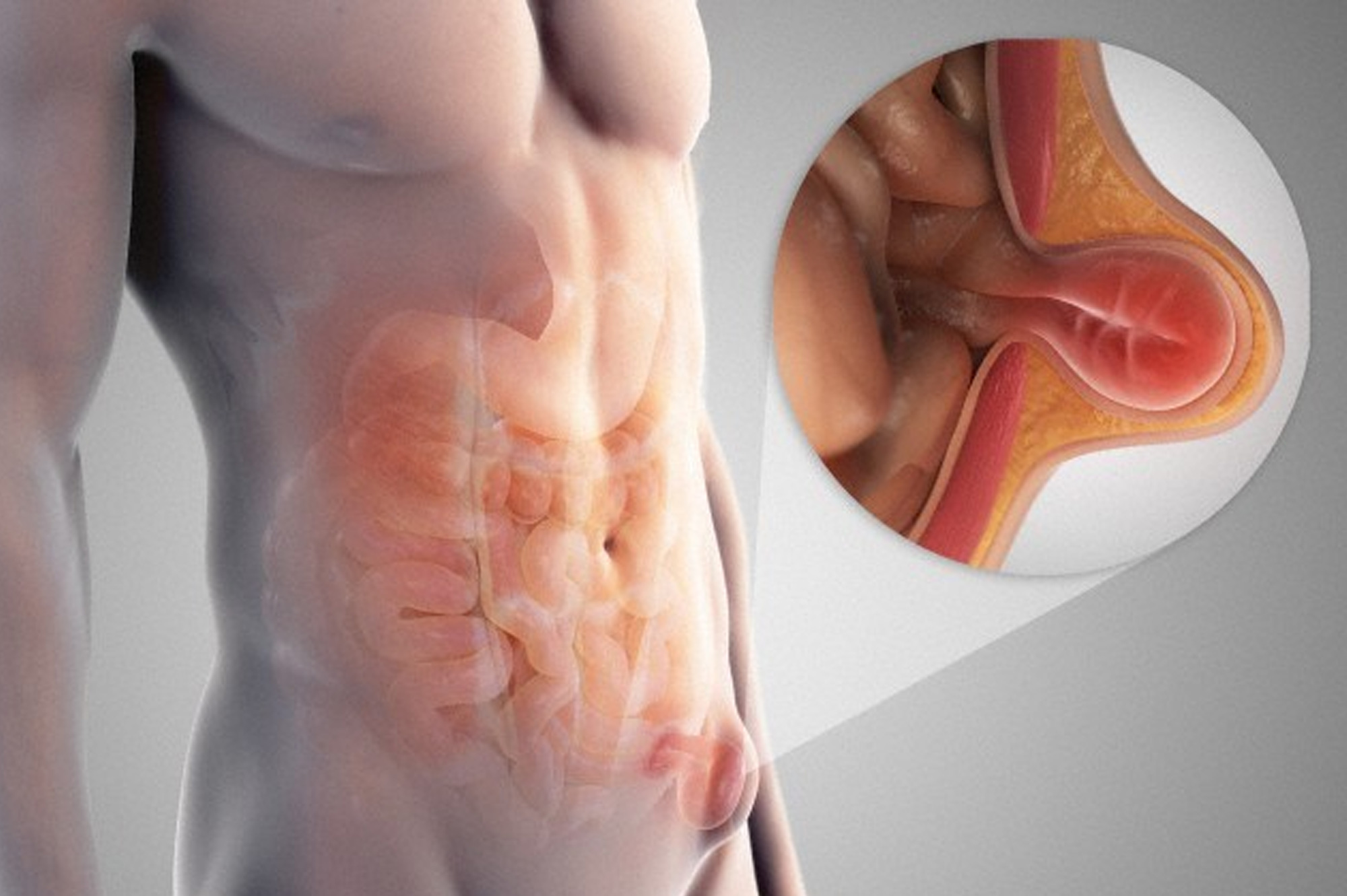 Hérnias de parede abdominal - Dr. Klevin Canuto